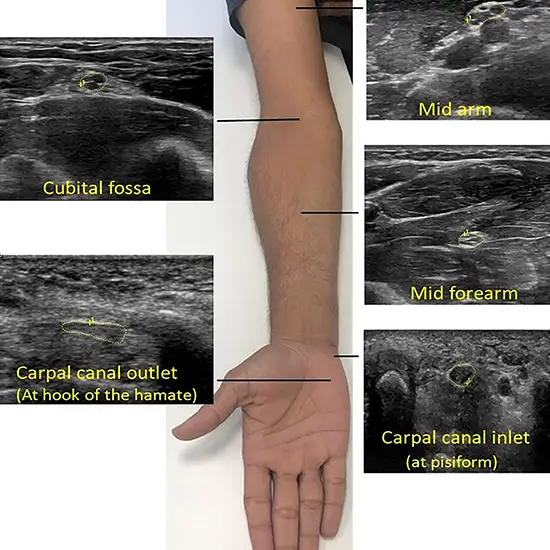 Ultrasound Forearm Test